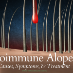 alopecia areata autoimmune hair loss
