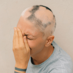 Woman with alopecia (hair loss) with a hand over her face crying.