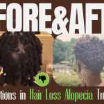 5 innovations in hair loss alopecia treatments. Before and after picture showing hair before treatment at Three D Wellness.